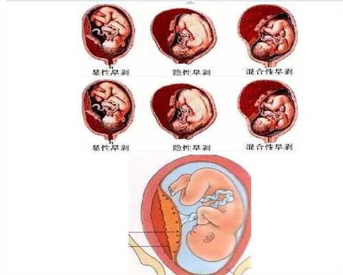 怀孕早期孕酮低，不是导致胎停的原因。相反，